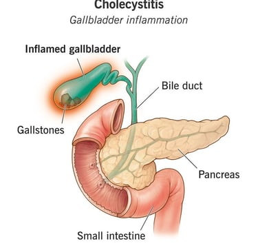 Cholecystitis GASTRO FOUNDATION