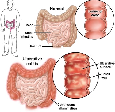 Colitis GASTRO FOUNDATION