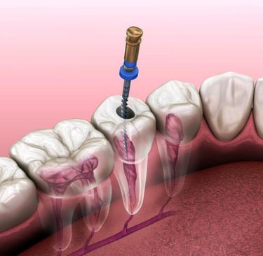 Endodoncia
