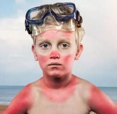 Dealing with Sunburns