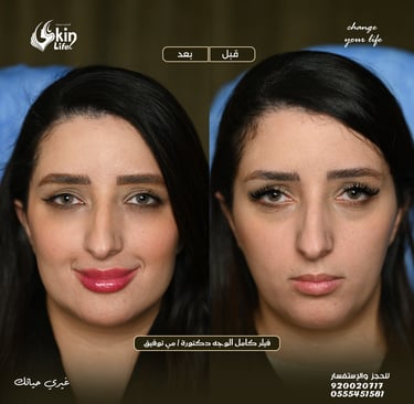 “نتائج فيلر شفايف طبيعية قبل وبعد – مركز Skin Life.”