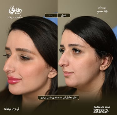 “صورة قبل وبعد فيلر شفايف وخدود لرفع وتحديد الوجنتين – Skin Life Clinic.”