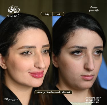 “صورة قبل وبعد علاج الفيلر لملء الخدود وتحسين ملامح الوجه – Skin Life Clinic.”