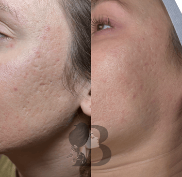 microneedling before and after