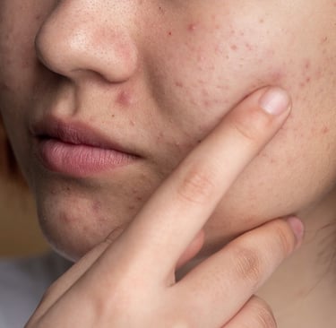 amabelle acne source & treatment
