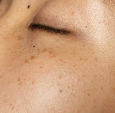 amabelle melasma
