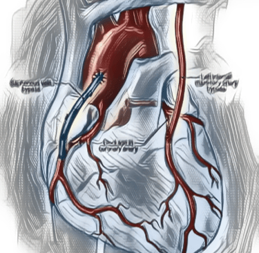 Advances in Bypass Surgery Dr. Anbarasu Mohanraj