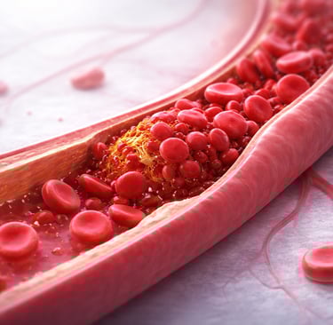 Ilustração médica de trombose mostrando coágulo sanguíneo em vaso, representando risco trombótico.