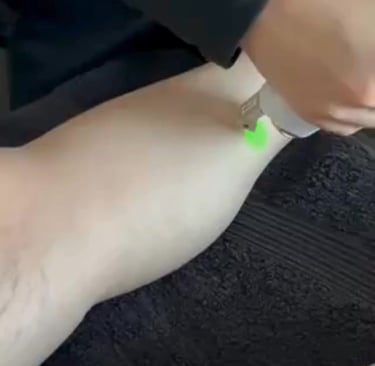 machine épilation laser jambes