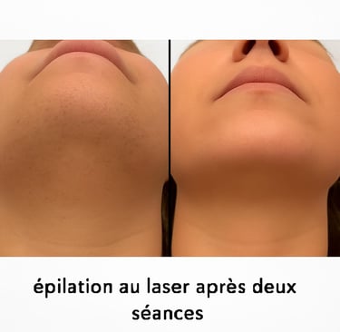 épilation laser avant / après menton