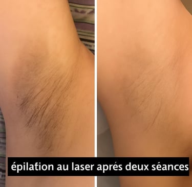 épilation laser avant / après aisselles