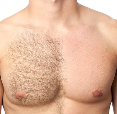 épilation laser homme