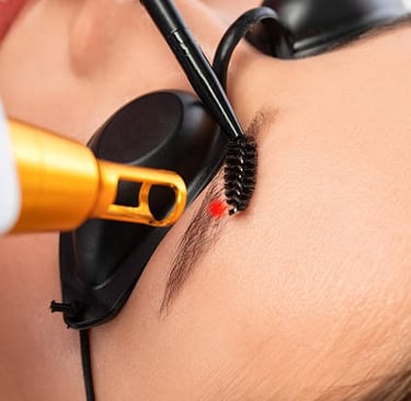 détatouage laser