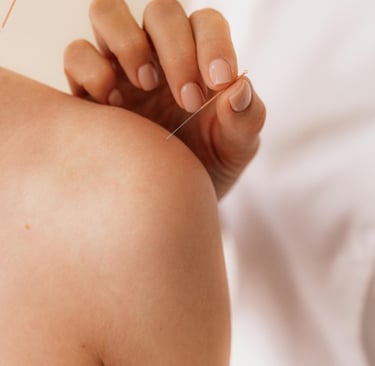 épaule, aiguille, acupuncture