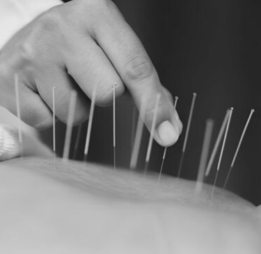 Dry Needling