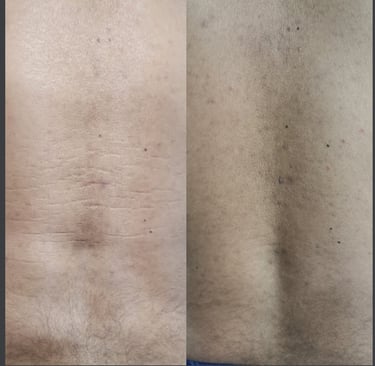 Avant et après : atténuation des vergetures masculines dans le dos.