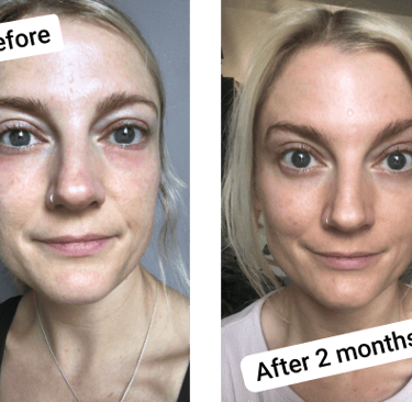 before and after collagen