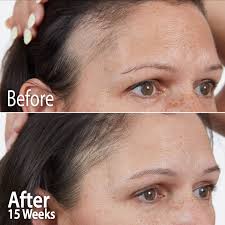 Hair regrow res