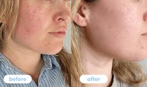Before and After peptides res