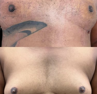 Ginecomastia - antes x depois