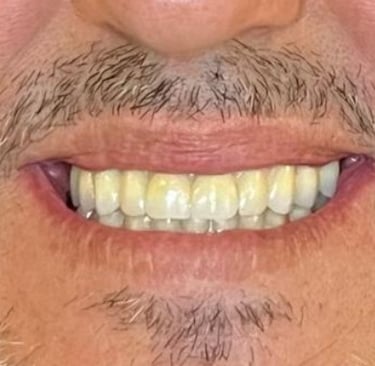 Procad Henares , rehabilitación circonio