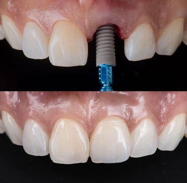 Before and after dental implant surgery showing a titanium post and a final natural-looking tooth crown.