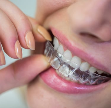 Invisalign - Studio Dentistico Dott. Pierluca Vivaldini - Gambara