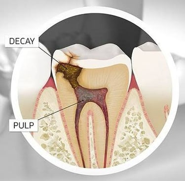 decay and cavity in tooth