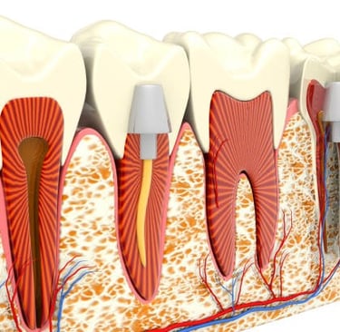 root canal step step explaination