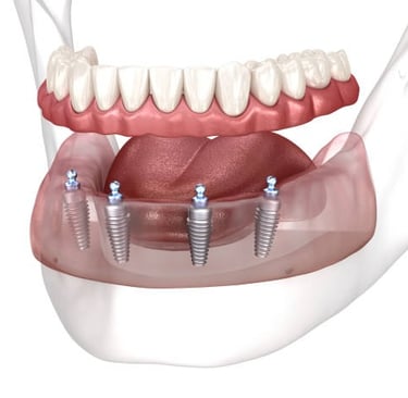 4 front dental implant at white castle dental clinic katraj pune