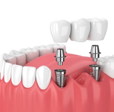 multiple dental implant