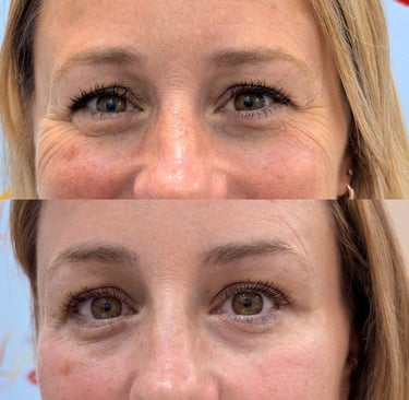 Botox en San José cerca de ti  Estamos ubicados en San José, Costa Rica, Escazu