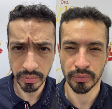 Botox para hombre San Jose Costa Rica