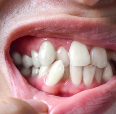 apinamiento dental