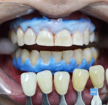 Blanqueamiento dental badajoz