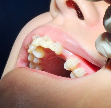 brackets infantil
