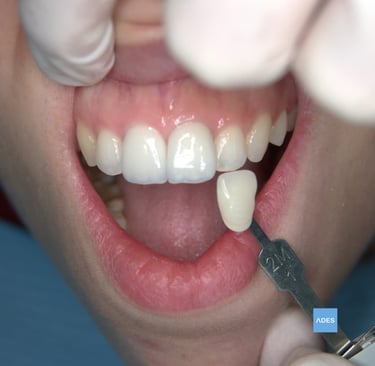 carillas dentales