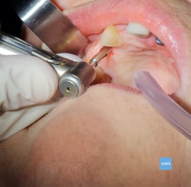 Implante dental