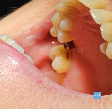 implante dental