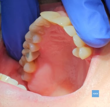 implante dental