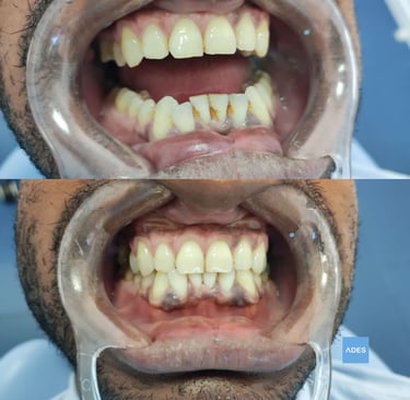 limpieza dental