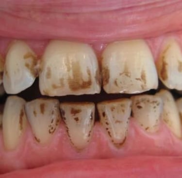 manchas dientes