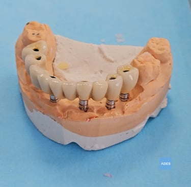 protesis sobre implantes
