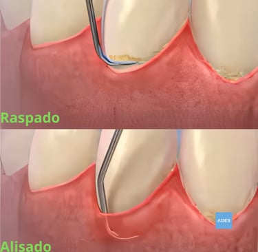 raspado radicular