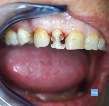 reconstruccion dental. clinica dental ades badajoz