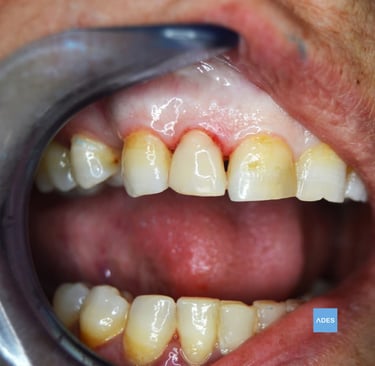 reconstrucción dental 