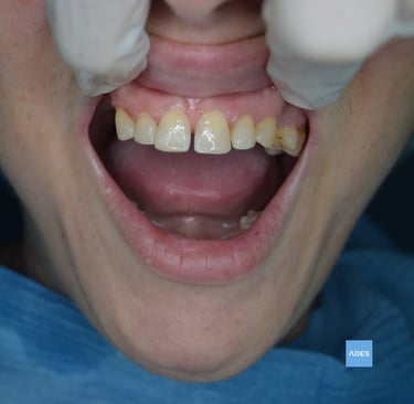 restauración dental