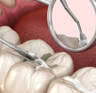 sellador dental