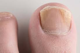 nail fungus