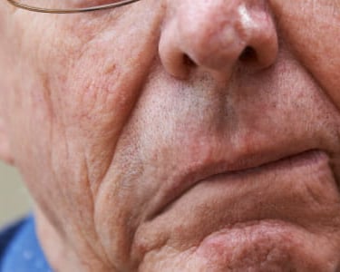 Sign of stroke: illustration of a face with one side drooping